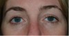 婦人覺得眼皮腫痛，而且還越脹越大，看醫生竟夾出「28年前的隱形眼鏡」
